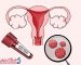 آزمایش خون HPV